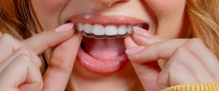 13 000 kr studentrabatt på Invisalign® hos Smile 2 Impress