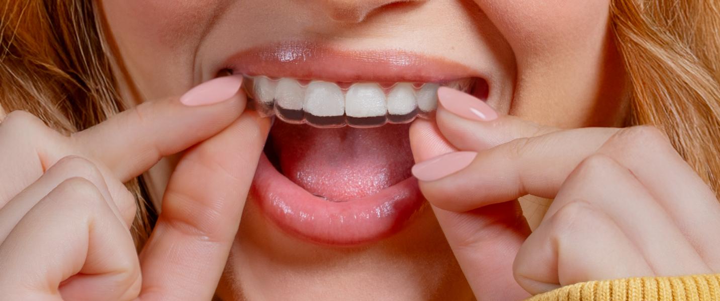 13 000 kr studentrabatt på Invisalign® hos Smile 2 Impress